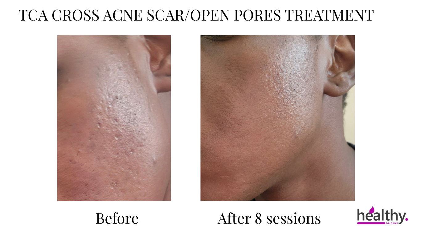 TCA CROSS ACNE SCAR & OPEN PORES TREATMENT ACCRA